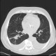 Bronchoinvasive aspergilosis: CT - Computed tomography